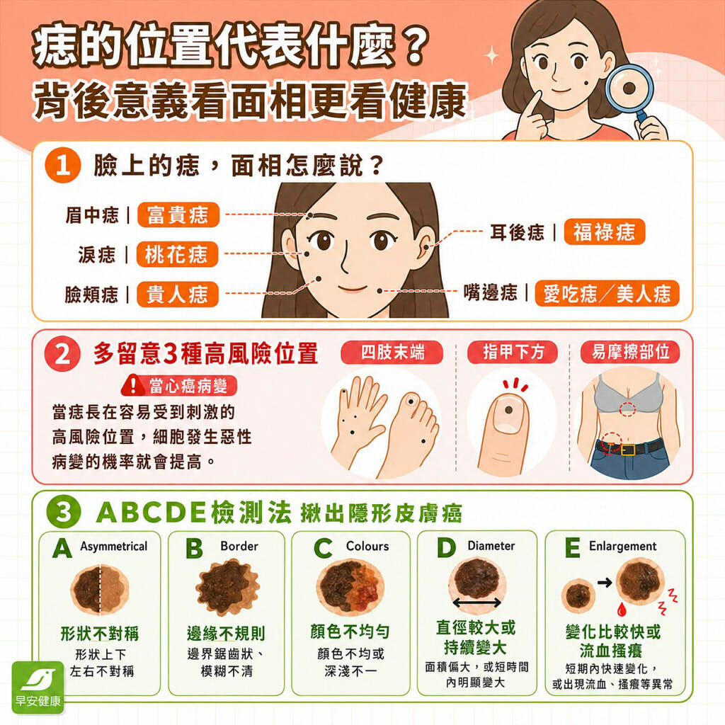 痣的位置代表什麼？這3處長痣要注意、自我檢測與安全除痣指南