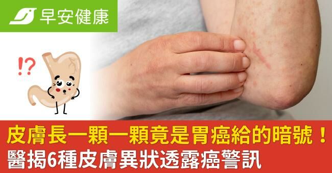 皮膚長一顆一顆竟是胃癌給的暗號!醫揭6種皮膚異狀透露癌警訊