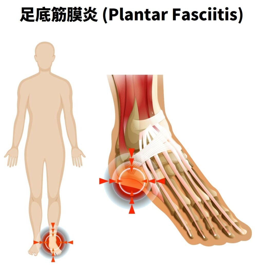 媽祖遶境最擔心的足部問題之一：足底筋膜炎