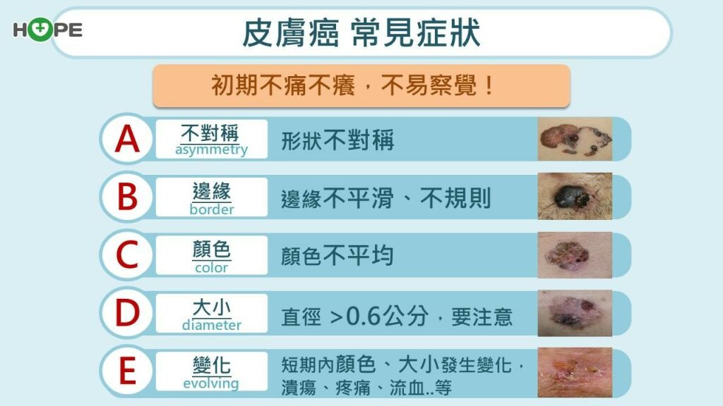 癌症希望基金會_皮膚癌常見症狀