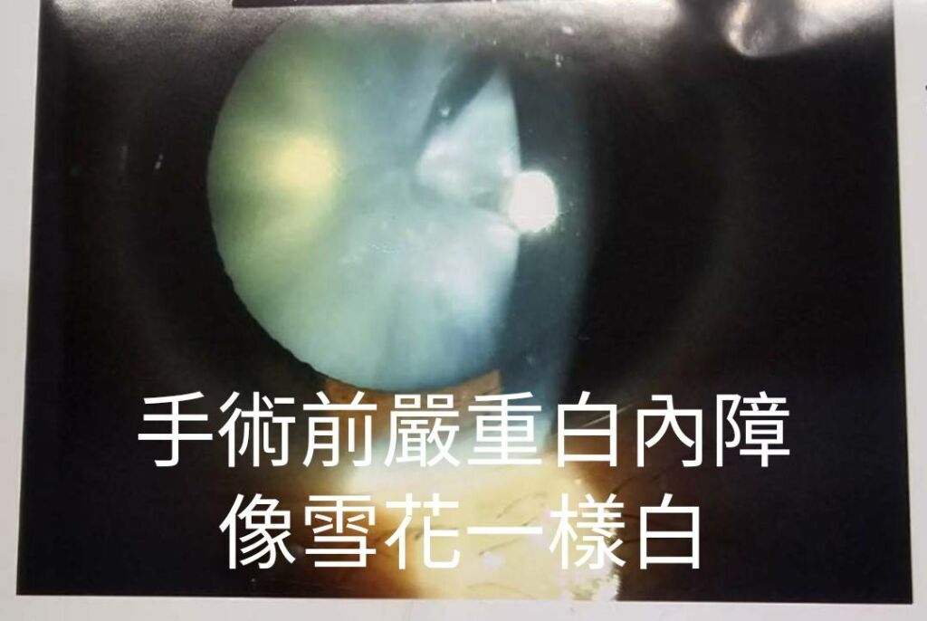 徐浩恩﻿醫師_高血糖白內障像雪花一樣白