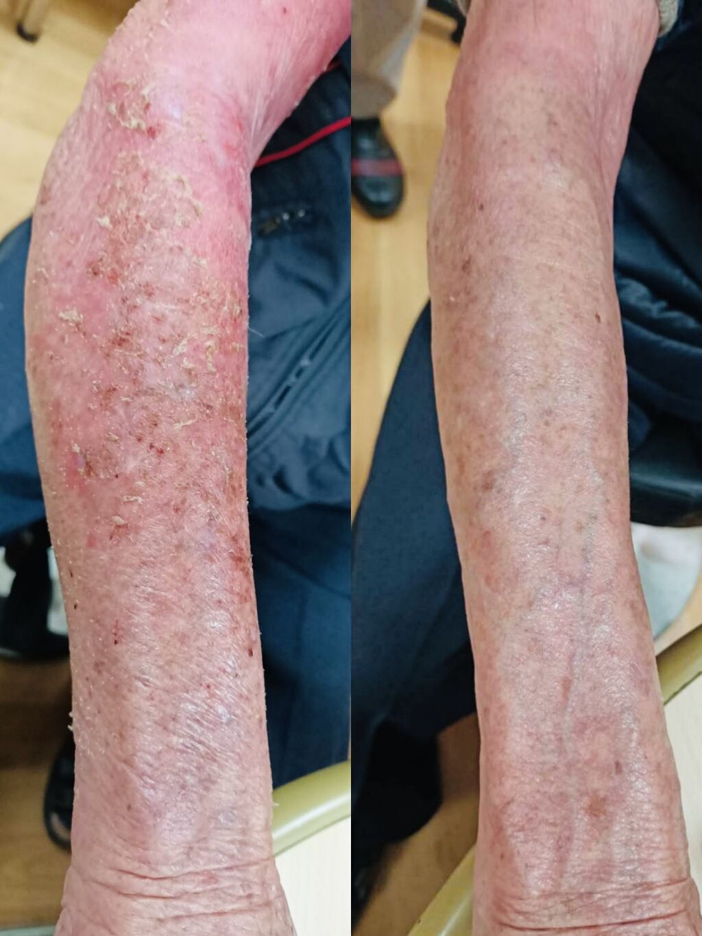 尿毒搔癢症的好發部位與特殊症狀