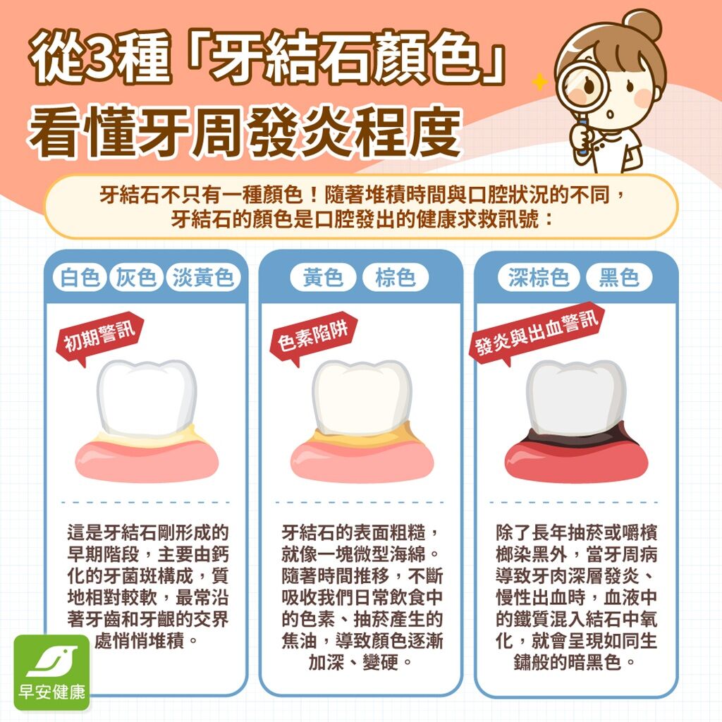 牙結石-牙結石顏色