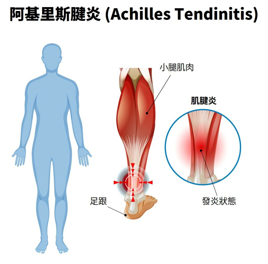 媽祖遶境最擔心的足部問題之一：阿基里斯腱炎
