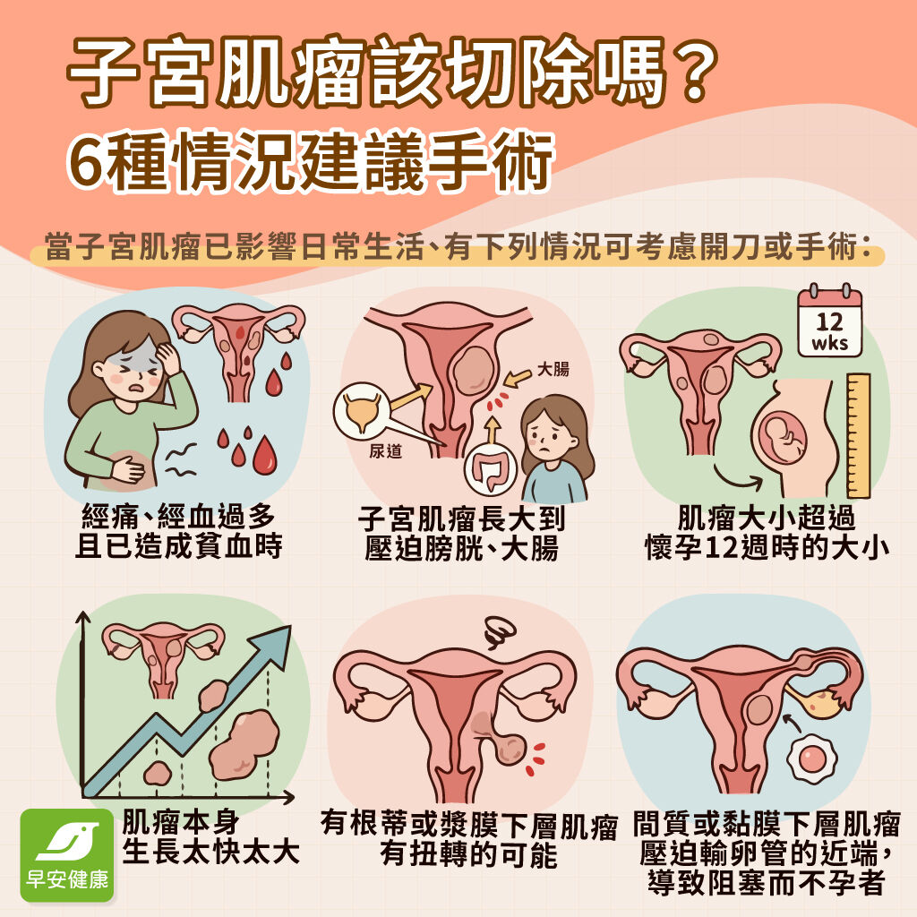 子宮肌瘤-子宮肌瘤怎麼辦-子宮肌瘤切除-子宮肌瘤治療-子宮肌瘤開刀-子宮肌瘤手術