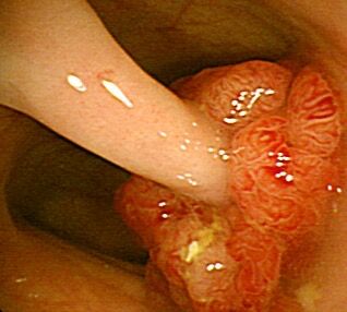 隆起型的腺瘤性息肉：有機會進展成大腸癌，需及時切除（張立群醫師提供）。