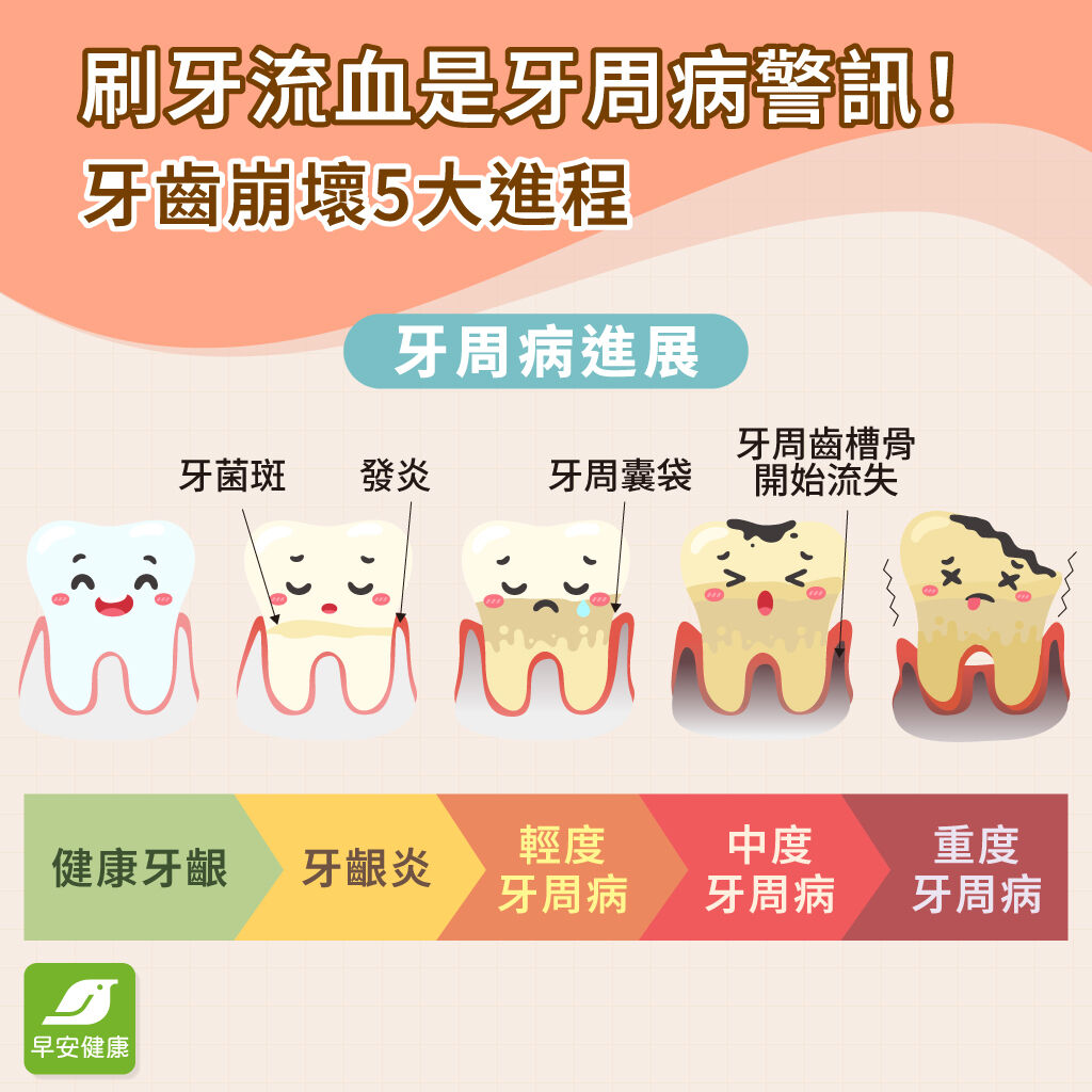 牙周病-牙周病進程