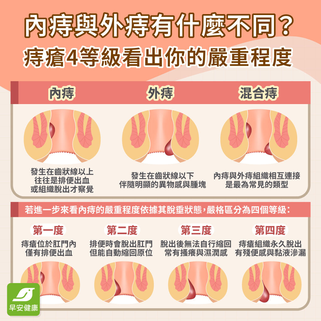 痔瘡-痔瘡症狀-內痔-外痔-混合痔-痔瘡會自己好嗎