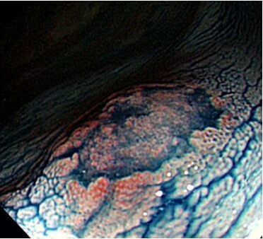 凹陷型腫瘤的腺瘤性息肉：運用化學藥水染色，讓惡性度極高的凹陷型腫瘤現形（張立群醫師提供）。