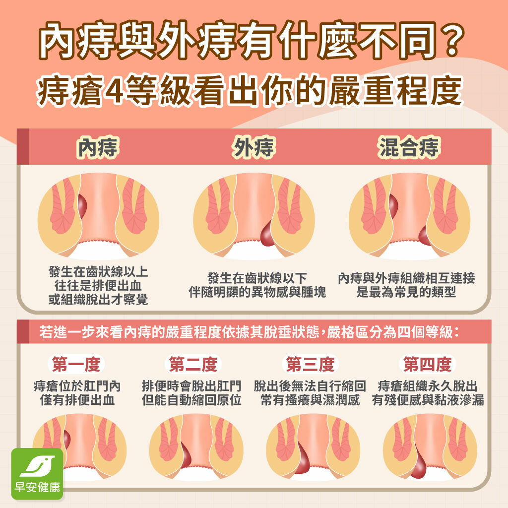 痔瘡症狀-痔瘡等級-內痔-外痔