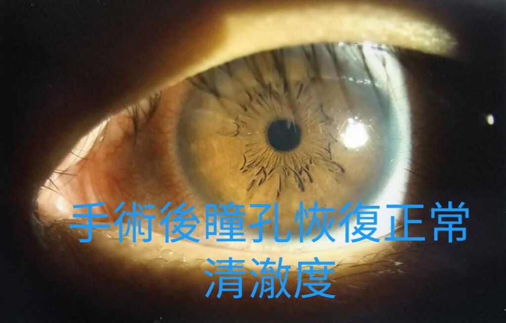 徐浩恩﻿醫師_高血糖白內障手術後＿眼睛恢復清澈