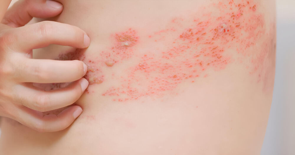 帶狀疱疹最常見的病灶是皮膚會出現一整片帶狀分布的皮疹與水泡,患者可能會感覺到皮膚癢、刺痛等症狀