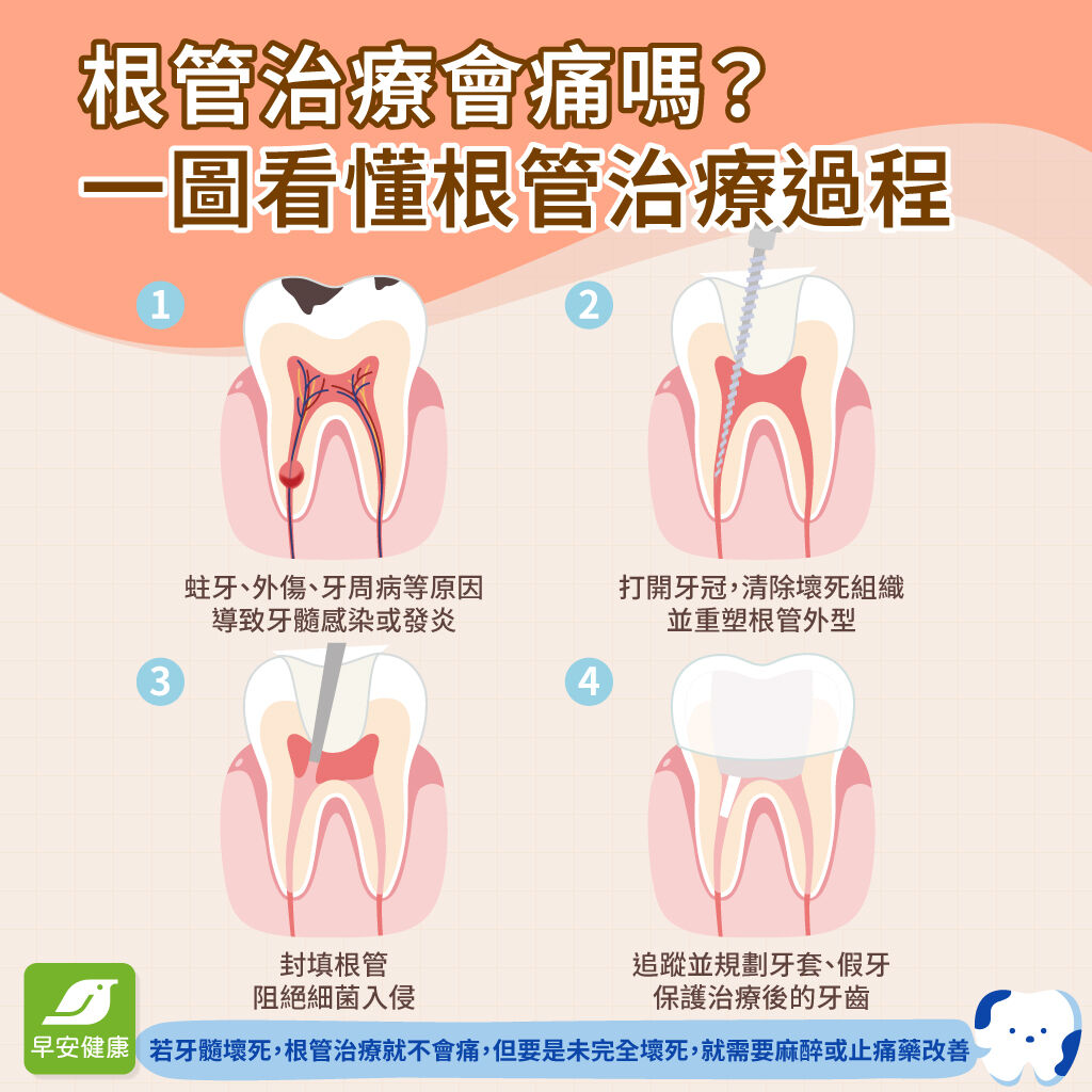 根管治療會痛嗎-根管治療流程-根管治療