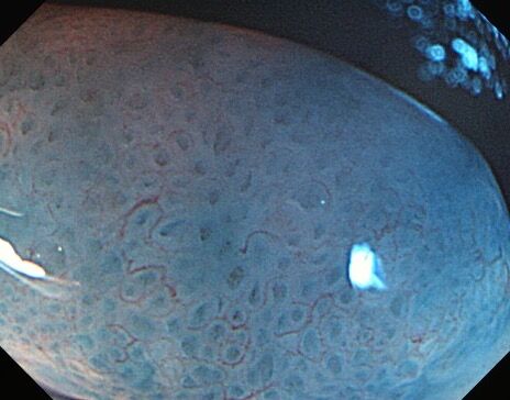 鋸齒狀的腺瘤性息肉：外觀並沒有鋸齒狀，而是病理切片時，會在顯微鏡下呈現鋸齒狀（張立群醫師提供）。