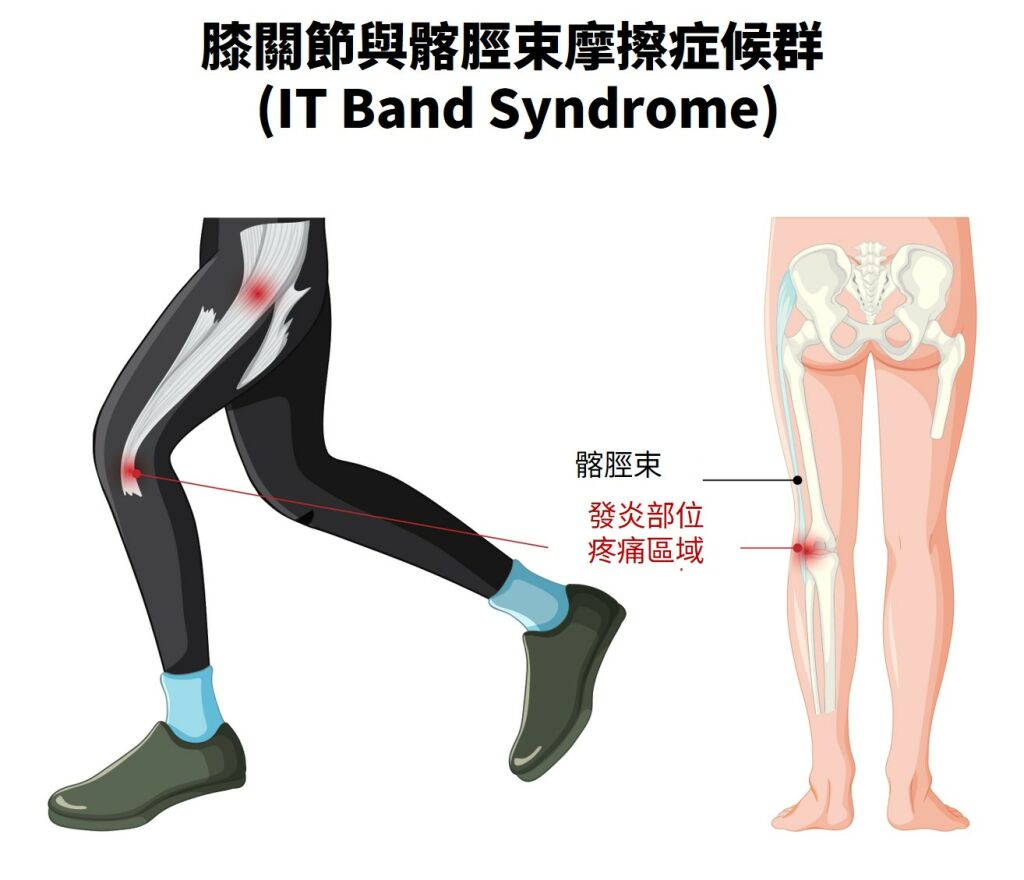 媽祖遶境最擔心的足部問題之一：膝關節與髂脛束摩擦症候群（ITBS症候群）