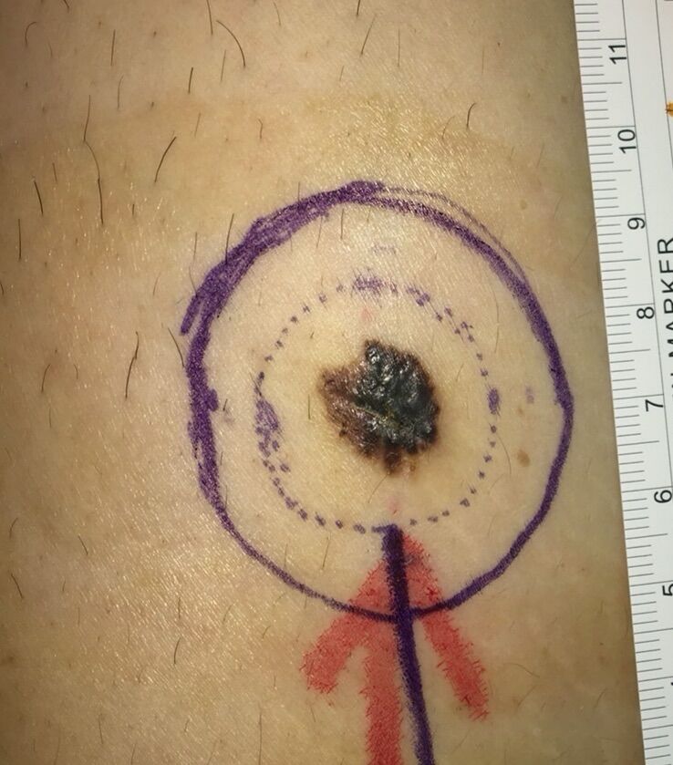 皮膚癌-惡性黑色素瘤