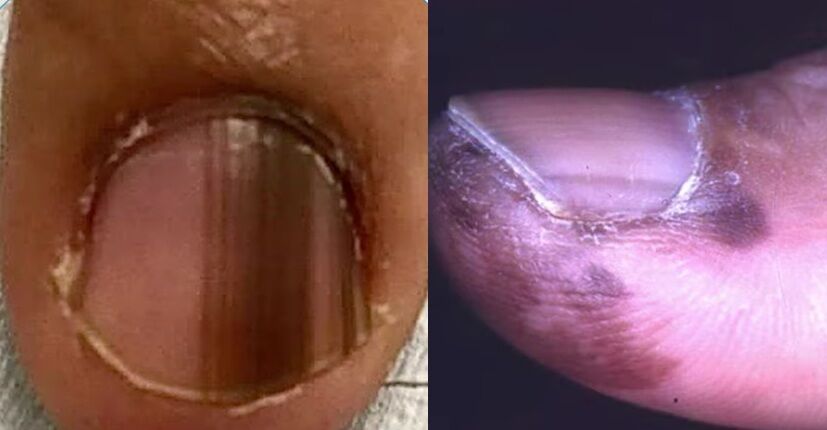 指甲黑線黑色素瘤