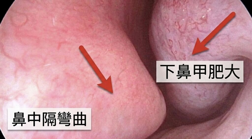 鼻中隔彎曲與下鼻甲肥大是造成長期鼻塞的原因之一